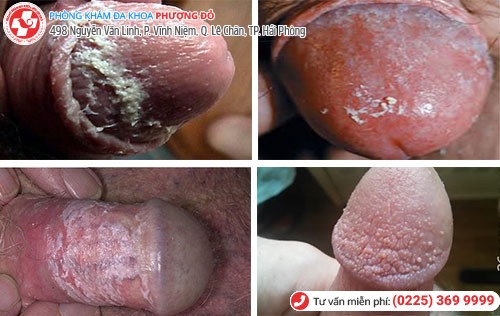 Đau buốt quy đầu do nhiễm nấm candida Đau buốt quy đầu do nhiễm nấm candida