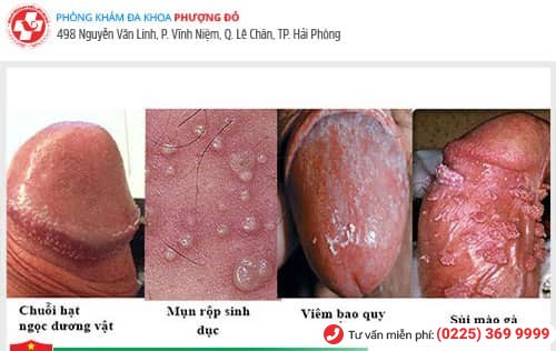 Đốm trắng dương vật là dấu hiệu nhiều bệnh nguy hiểm Đốm trắng dương vật là dấu hiệu nhiều bệnh nguy hiểm
