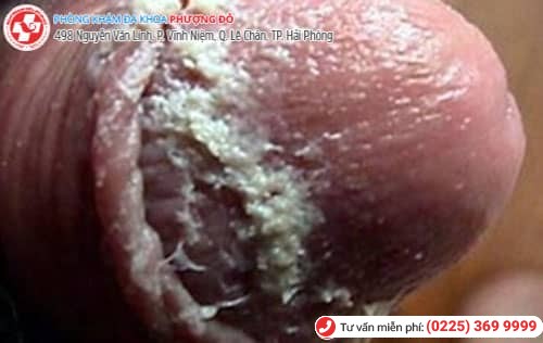 Vệ sinh cơ quan sinh dục không sạch sẽ khiến dương vật nổi đốm trắng Vệ sinh cơ quan sinh dục không sạch sẽ khiến dương vật nổi đốm trắng