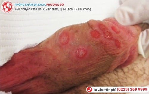 Dương vật mưng mủ vì xịt thuốc chống xuất tinh sớm Dương vật mưng mủ vì xịt thuốc chống xuất tinh sớm