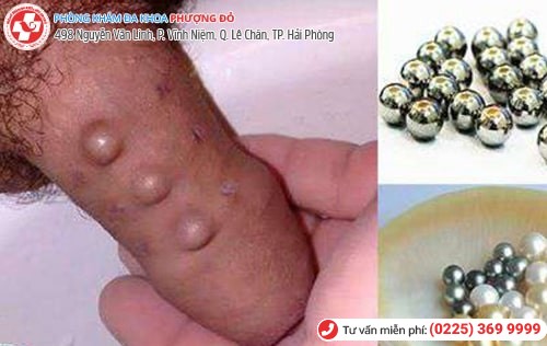 gắn bi dương vật