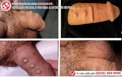 gắn bi ở dương vật