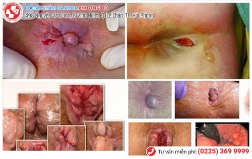 hậu môn chảy dịch mủ vàng