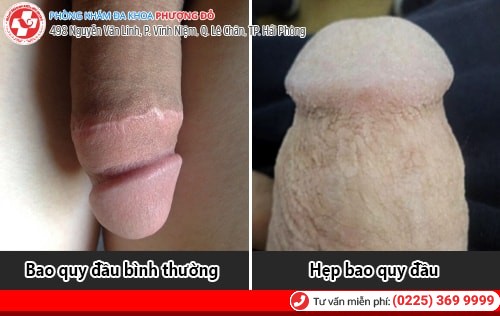 Hẹp bao quy đầu là gì? Cách chữa hẹp bao quy đầu hiệu quả Hẹp bao quy đầu là gì? Cách chữa hẹp bao quy đầu hiệu quả