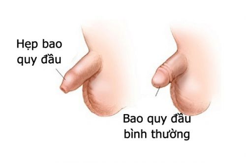  Hình ảnh bao quy đầu bình thường ở người lớn: Nhận biết và Phân biệt