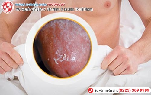 Dài, hẹp, viêm bao quy đầu nên tiểu phẫu cắt bao quy đầu sớm Dài, hẹp, viêm bao quy đầu nên tiểu phẫu cắt bao quy đầu sớm