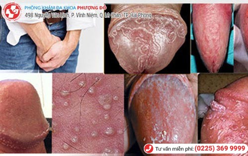 Dấu hiệu bệnh nam khoa đi khám ngay Dấu hiệu bệnh nam khoa đi khám ngay