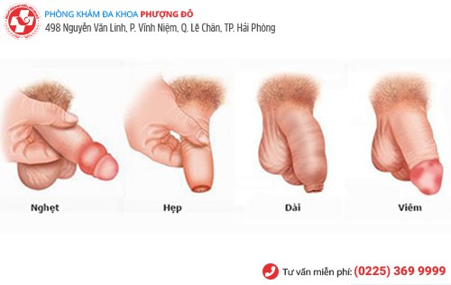 lột bao quy đầu