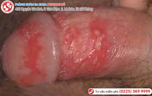 Mụn rộp sinh dục khiến nam giới bị sưng ở quy đầu Mụn rộp sinh dục khiến nam giới bị sưng ở quy đầu