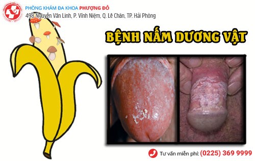 Hình ảnh bệnh nấm dương vật ở nam giới Bệnh nấm dương vật