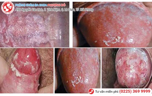 Biểu hiện nấm dương vật Biểu hiện nấm dương vật