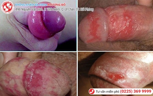 Ngứa bao quy đầu là bị bệnh gì? Có nguy hiểm không? Ngứa bao quy đầu là bị bệnh gì? Có nguy hiểm không?
