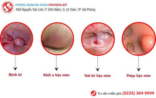Nguy hiểm rình rập khi bị chảy máu hậu môn Nguy hiểm rình rập khi bị chảy máu hậu môn