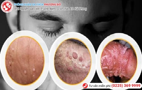 nguyên nhân gây ngứa dương vật