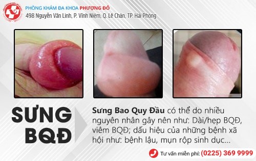 Sưng bao quy đầu là bị bệnh gì? Có nguy hiểm không? Sưng bao quy đầu là bị bệnh gì? Có nguy hiểm không?