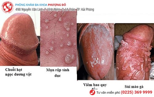 nổi mụn bao quy đầu
