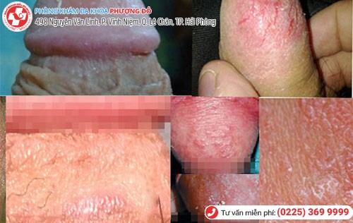 hình ảnh nứt bao quy đầu