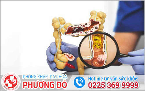 Cách điều trị polyp đại tràng hiện nay