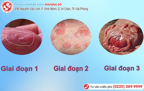 biểu hiện sùi mào gà ở dương vật