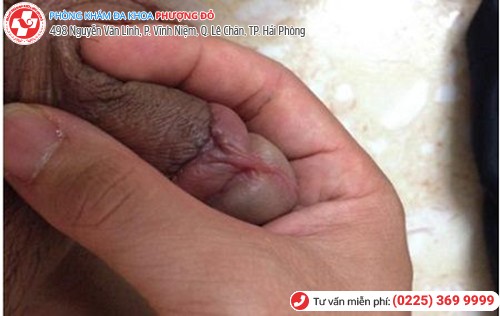 sưng da bao quy đầu