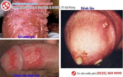 Sưng dương vật