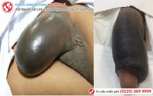 sưng dương vật