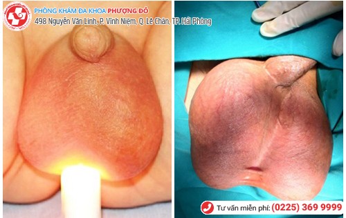 hình ảnh sưng tinh hoàn