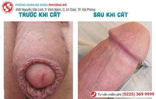 Súyt mất của quý vì tự cắt bao quy đầu tại nhà Súyt mất của quý vì tự cắt bao quy đầu tại nhà
