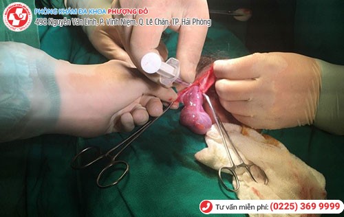 Bệnh nhân được phẫu thuật tháo xoắn tinh hoàn tại Phượng Đỏ Bệnh nhân được phẫu thuật tháo xoắn tinh hoàn tại Phượng Đỏ