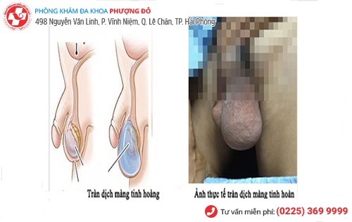 hình ảnh tràn dịch màng tinh hoàn