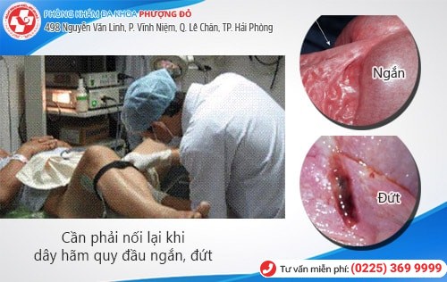 Trường hợp nào cần nối dây hãm quy đầu? Phương pháp nối dây hãm an toàn Trường hợp nào cần nối dây hãm quy đầu? Phương pháp nối dây hãm an toàn