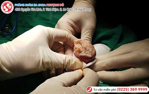 biến chứng hẹp bao quy đầu
