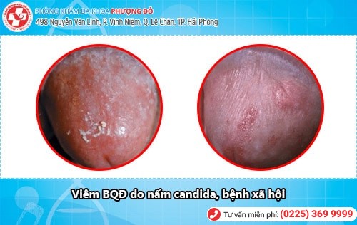 Hình ảnh viêm bao quy đầu. Viêm bao quy đầu có nguy hiểm không? Hình ảnh viêm bao quy đầu. Viêm bao quy đầu có nguy hiểm không?
