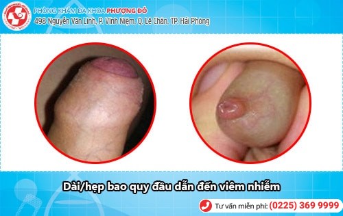 Hình ảnh viêm bao quy đầu. Viêm bao quy đầu có nguy hiểm không? Hình ảnh viêm bao quy đầu. Viêm bao quy đầu có nguy hiểm không?