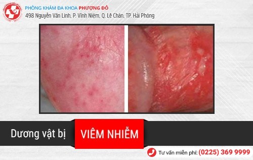 Viêm dương vật là gì? Điều trị bằng phương pháp nào hiệu quả? Viêm dương vật là gì? Điều trị bằng phương pháp nào hiệu quả?