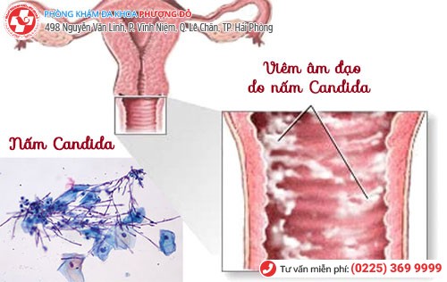 Âm đạo chảy dịch bất thường có nguyên nhân do đâu? Âm đạo chảy dịch bất thường có nguyên nhân do đâu?