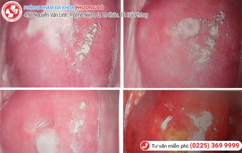 hình ảnh bệnh âm đạo