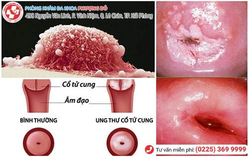 Viêm cổ tử cung có thể gây ung thư nếu bệnh tái lại nhiều lần Viêm cổ tử cung có thể gây ung thư nếu bệnh tái lại nhiều lần