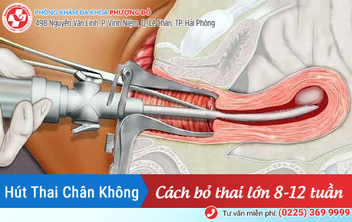 Bỏ thai lớn được không? Cách bỏ thai lớn từ 8 đến 12 tuần