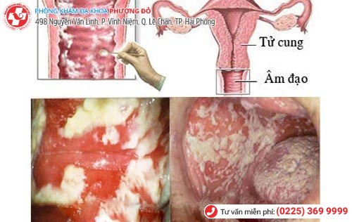 Viêm âm đạo - bệnh phụ khoa thường gặp nhất Viêm âm đạo - bệnh phụ khoa thường gặp nhất