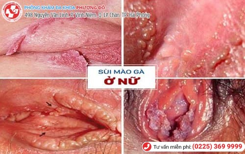 bệnh vùng kín bệnh vùng kín