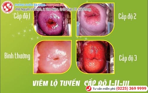 Hình ảnh viêm lộ tuyến cổ tử cung qua các cấp độ Hình ảnh viêm lộ tuyến cổ tử cung qua các cấp độ