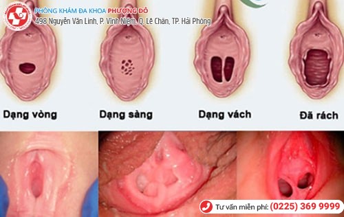 Các dạng màng trinh Các dạng màng trinh