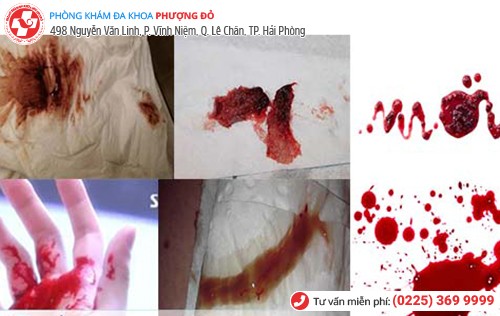 chảy máu âm đạo