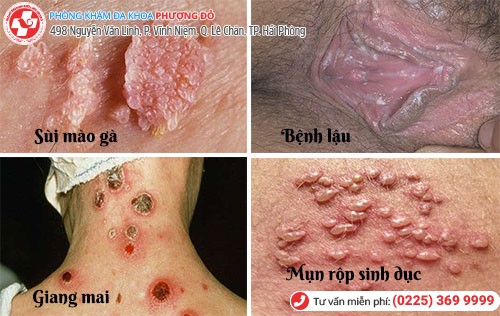 Chị em nên cảnh giác với triệu chứng đau rát âm đạo Chị em nên cảnh giác với triệu chứng đau rát âm đạo
