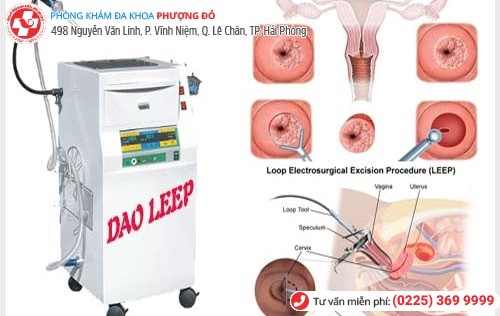 Dao LEEP là công nghệ chữa viêm cổ tử cung hiệu quả hiện nay