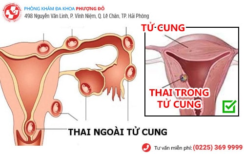 thuốc phá thai 1 tháng