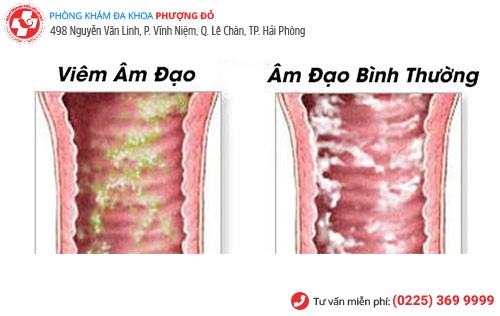 Hiện tượng hôi âm đạo ở nữ giới là dấu hiệu của bệnh gì? Hiện tượng hôi âm đạo ở nữ giới là dấu hiệu của bệnh gì?