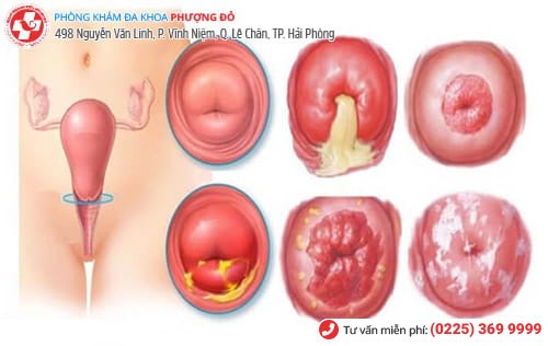 viêm lộ tuyến cổ tử cung viêm lộ tuyến cổ tử cung