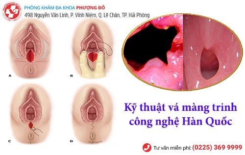Vá màng trinh công nghệ xâm lấn tối thiểu Hàn Quốc Vá màng trinh công nghệ xâm lấn tối thiểu Hàn Quốc